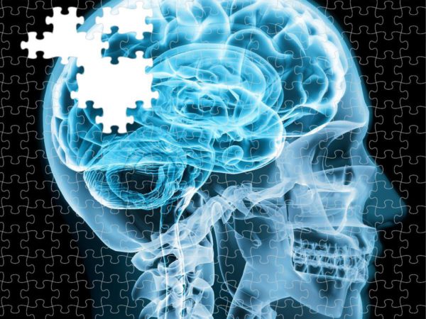 Alzheimer’s is a diabetic disorder of the brain, researchers find