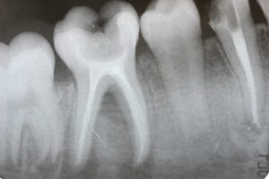 root canal dangers