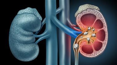 oral antibiotics and kidney stones Antibiotics identified as risk factors for kidney stones